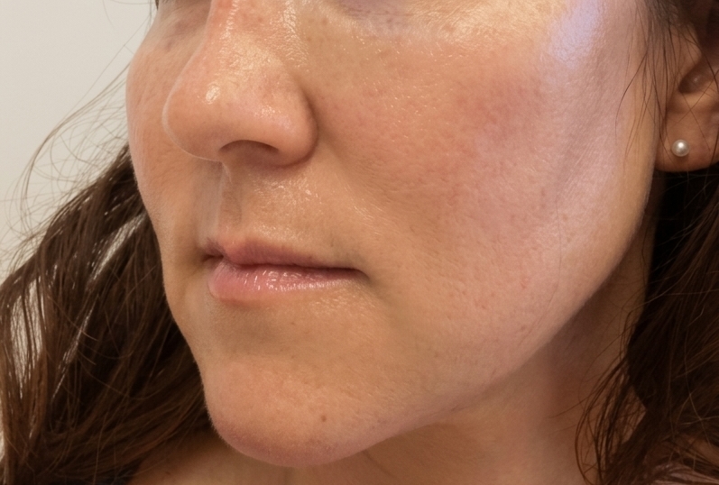 Rosacea After