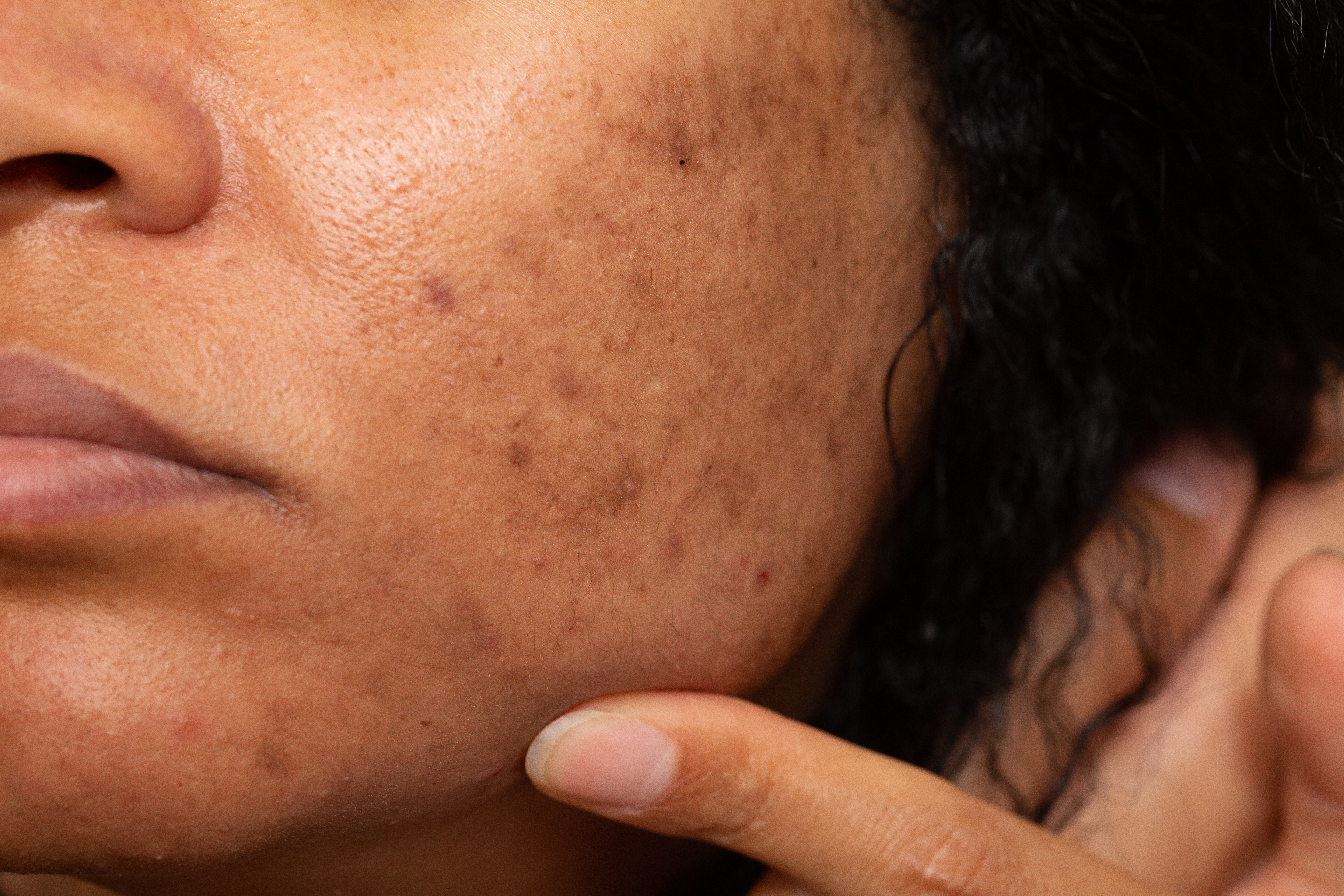 IPL Treatment for Pigmentation