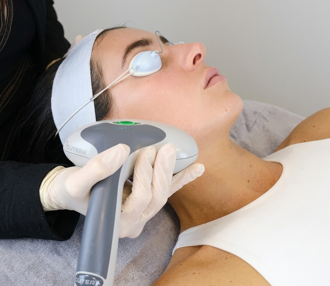 IPL Treatment