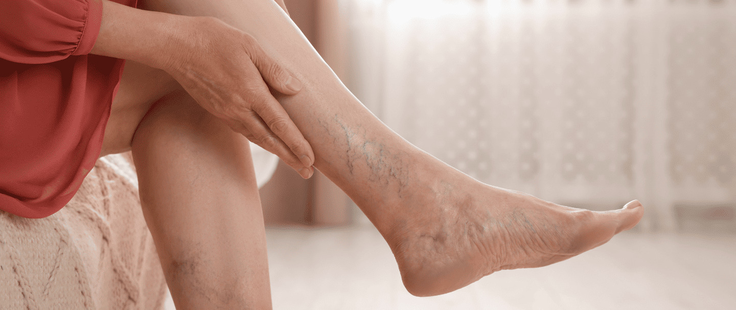 Featured: Varicose Veins